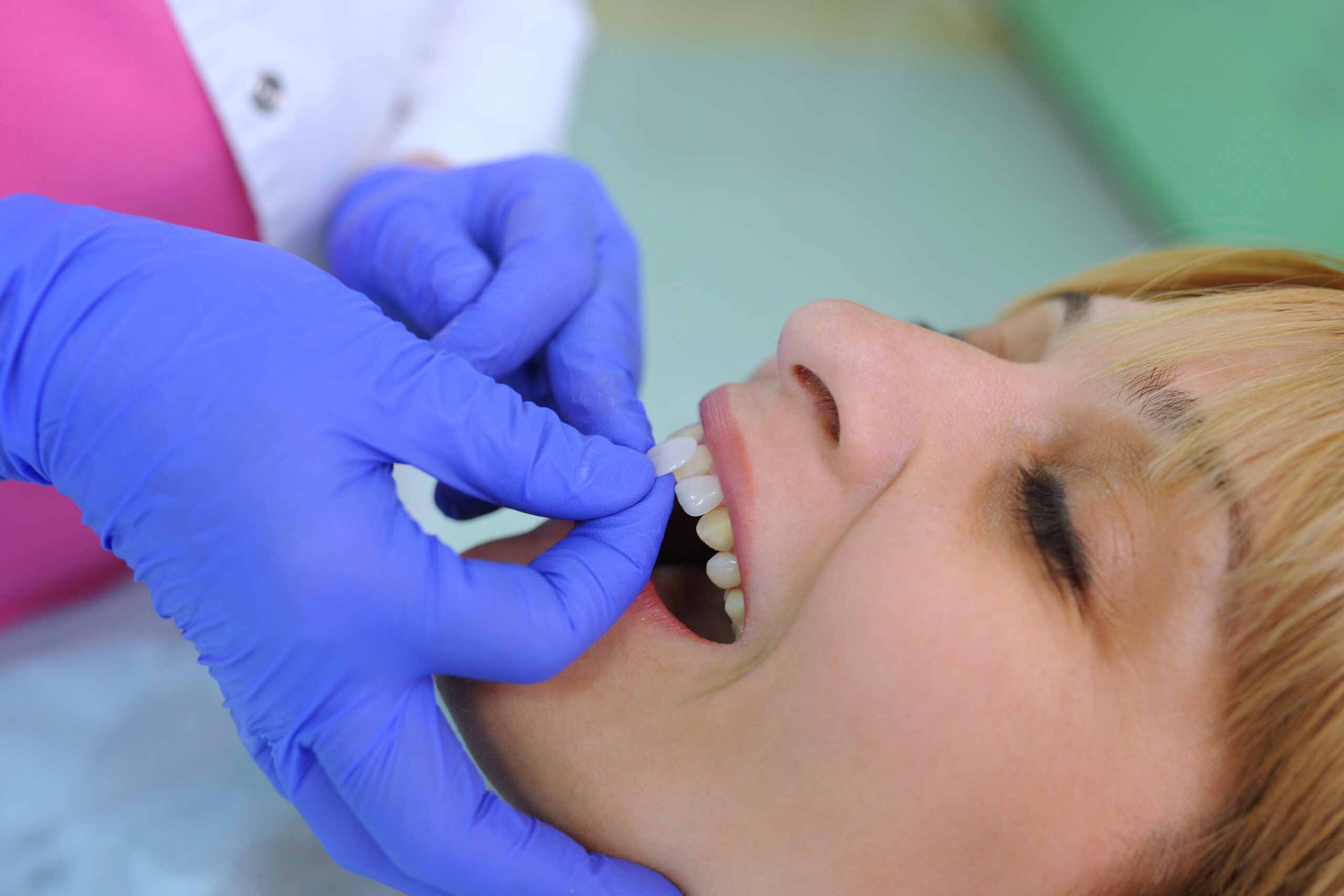 Veneers On Finance
