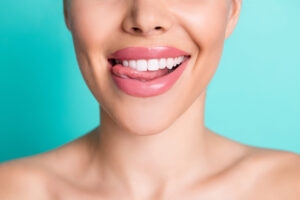 composite veneers