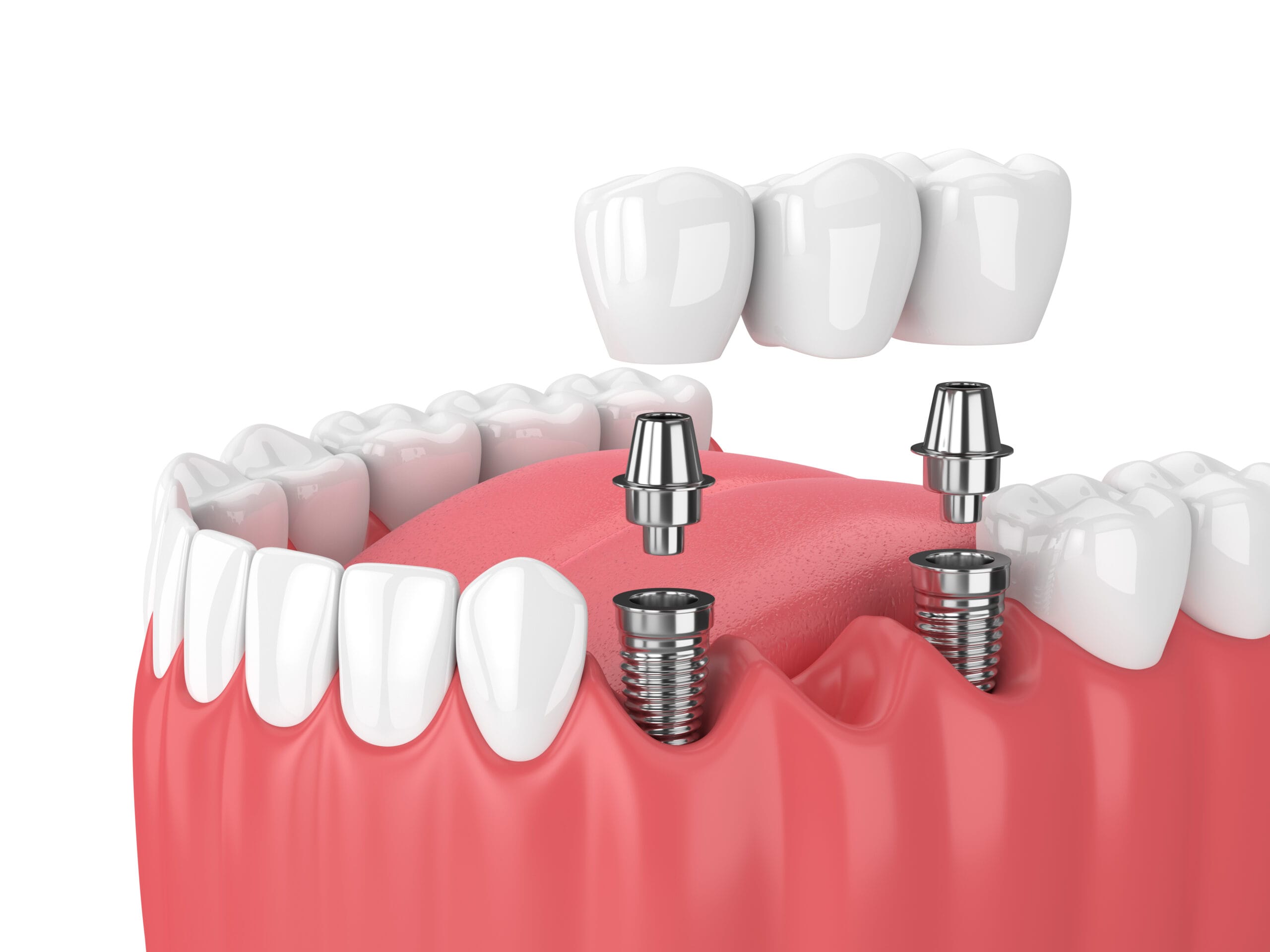 cheap tooth implant