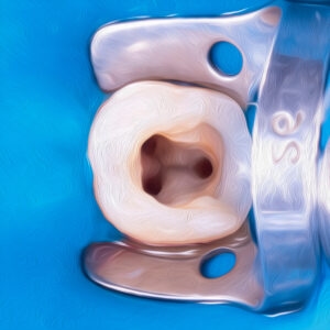 root canal treatment