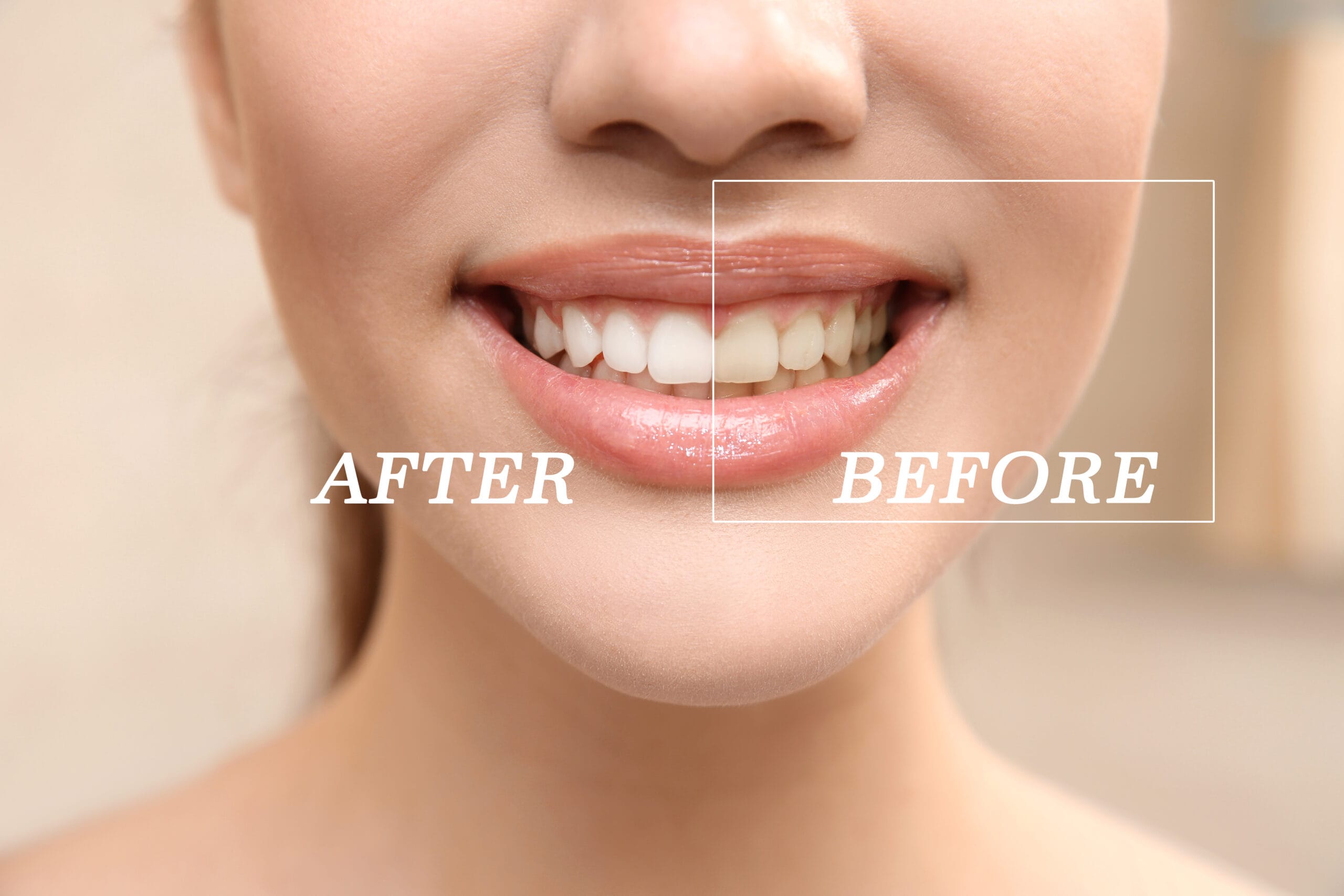 best teeth whitening in london