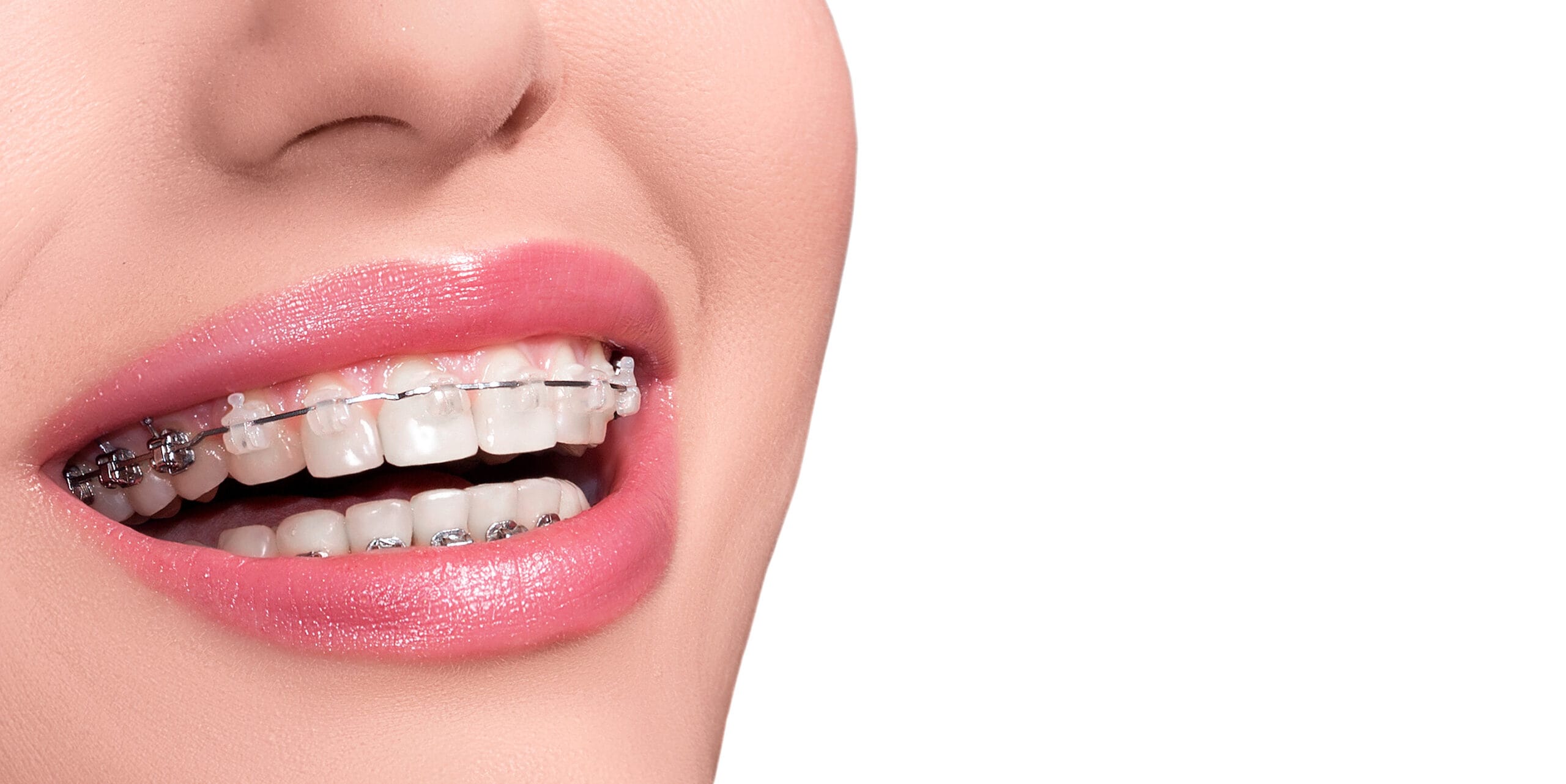 braces on finance