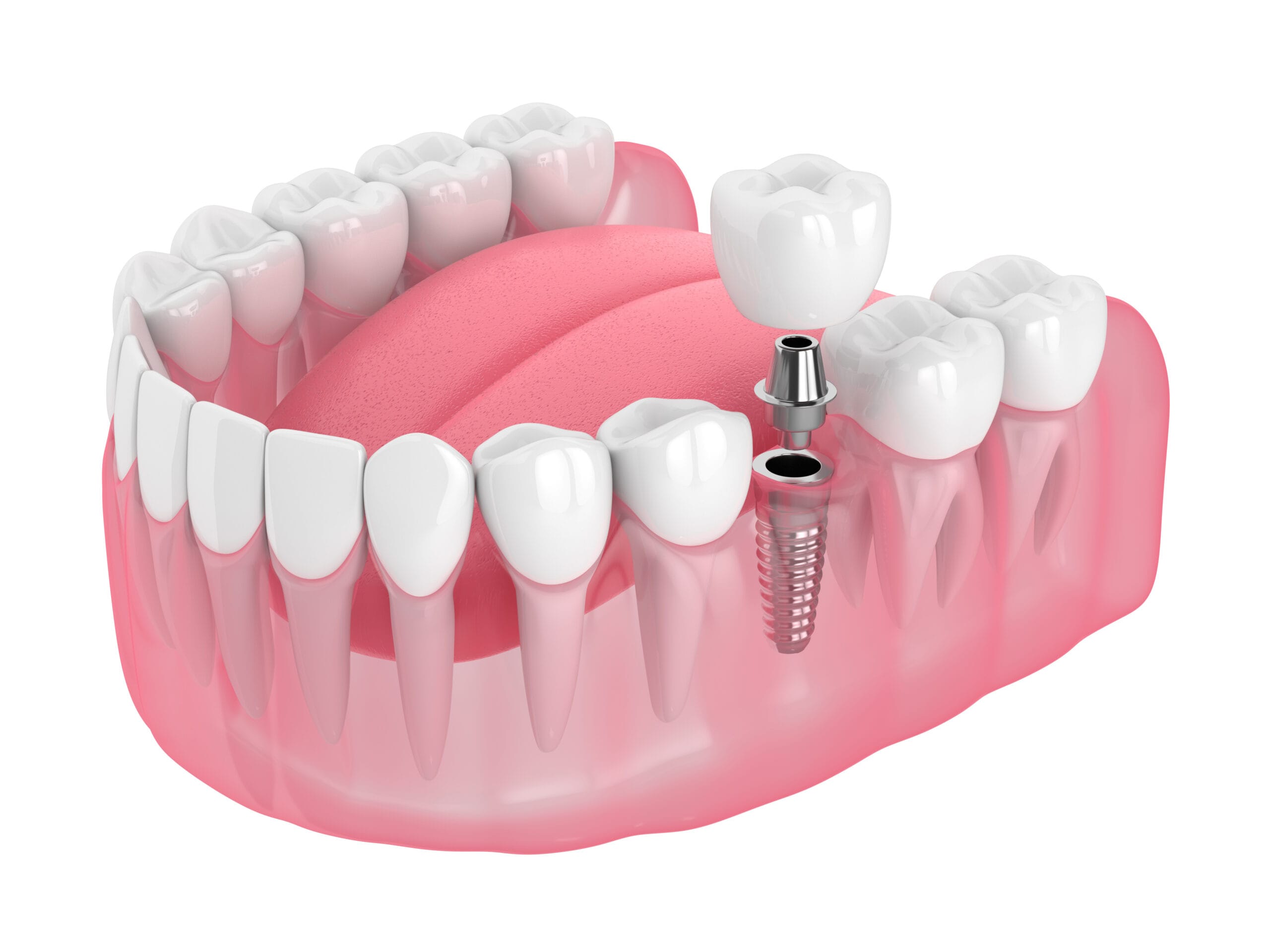 Tooth Implant Cost UK