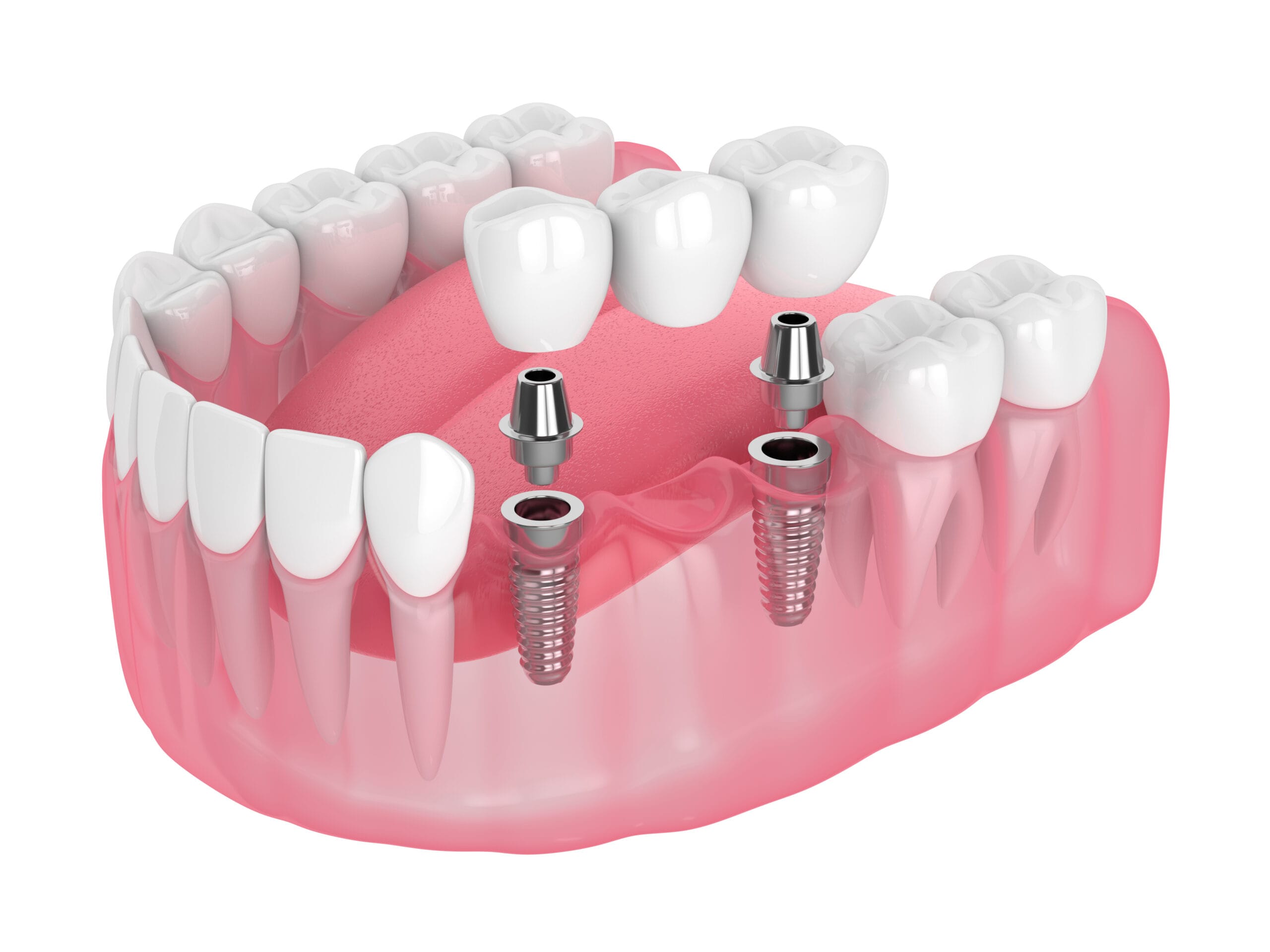 Dental Implant Clinics