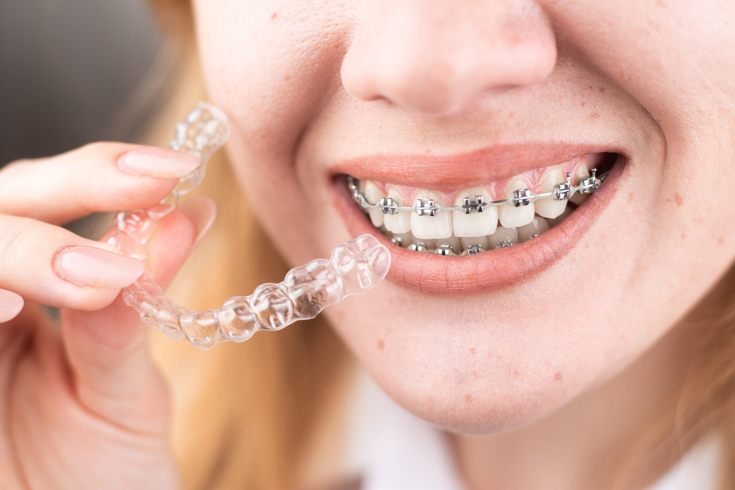 How Much Do Invisible Braces Cost