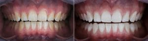composite bonding before & after