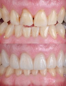 dental veneers