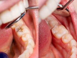 emergency dental filling