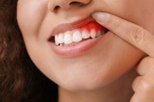 tooth abscess treatment