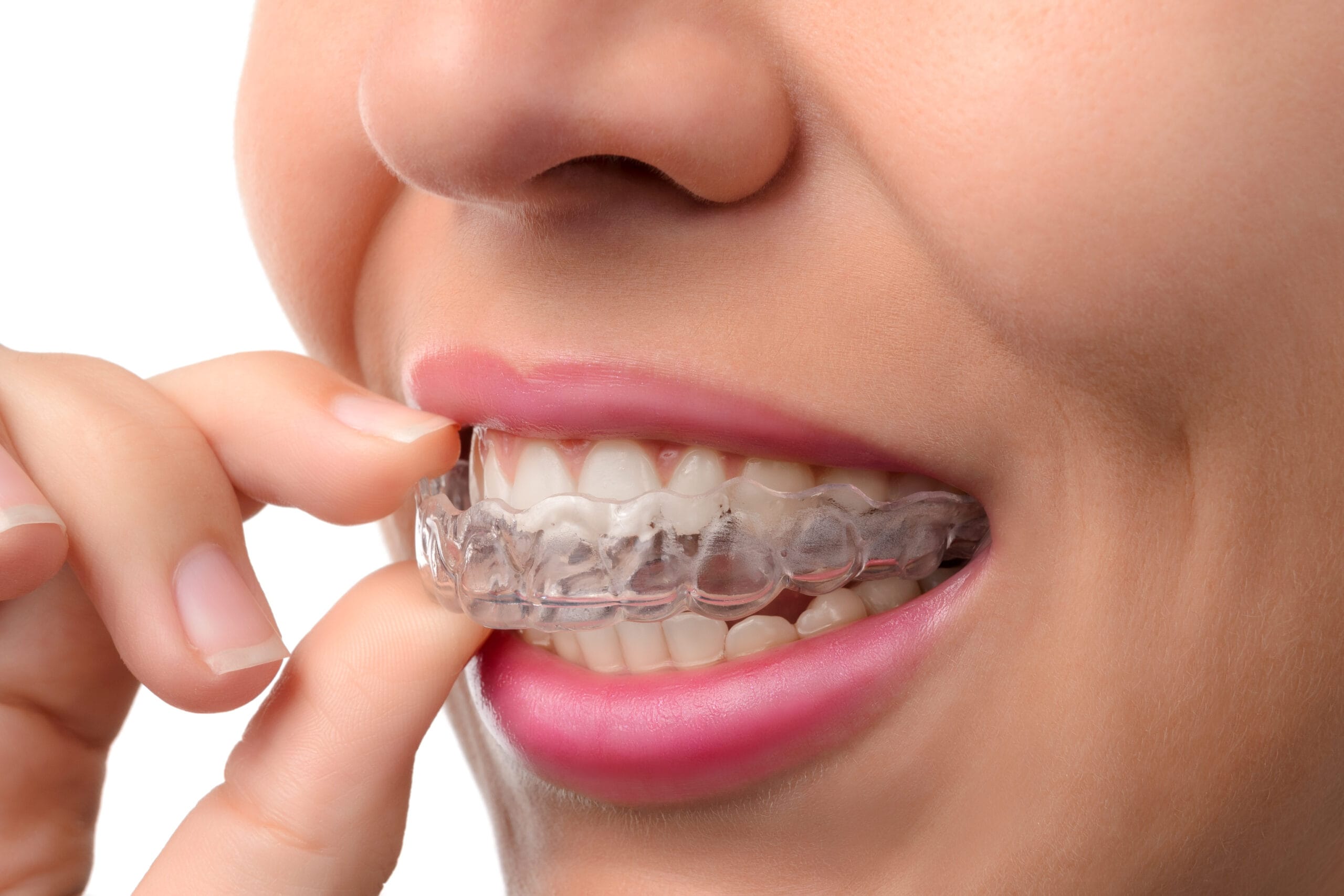 Invisalign orthodontist