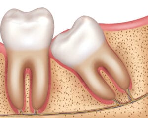 Growing wisdom tooth pain