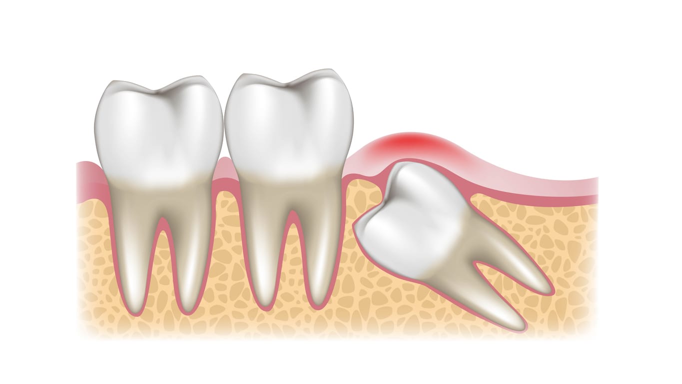 Growing wisdom tooth pain