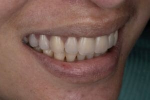 overdenture