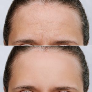 botox facial aesthetics