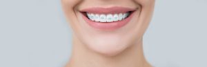 ceramic braces