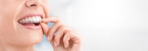 invisalign