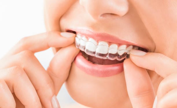 Half Price Invisalign