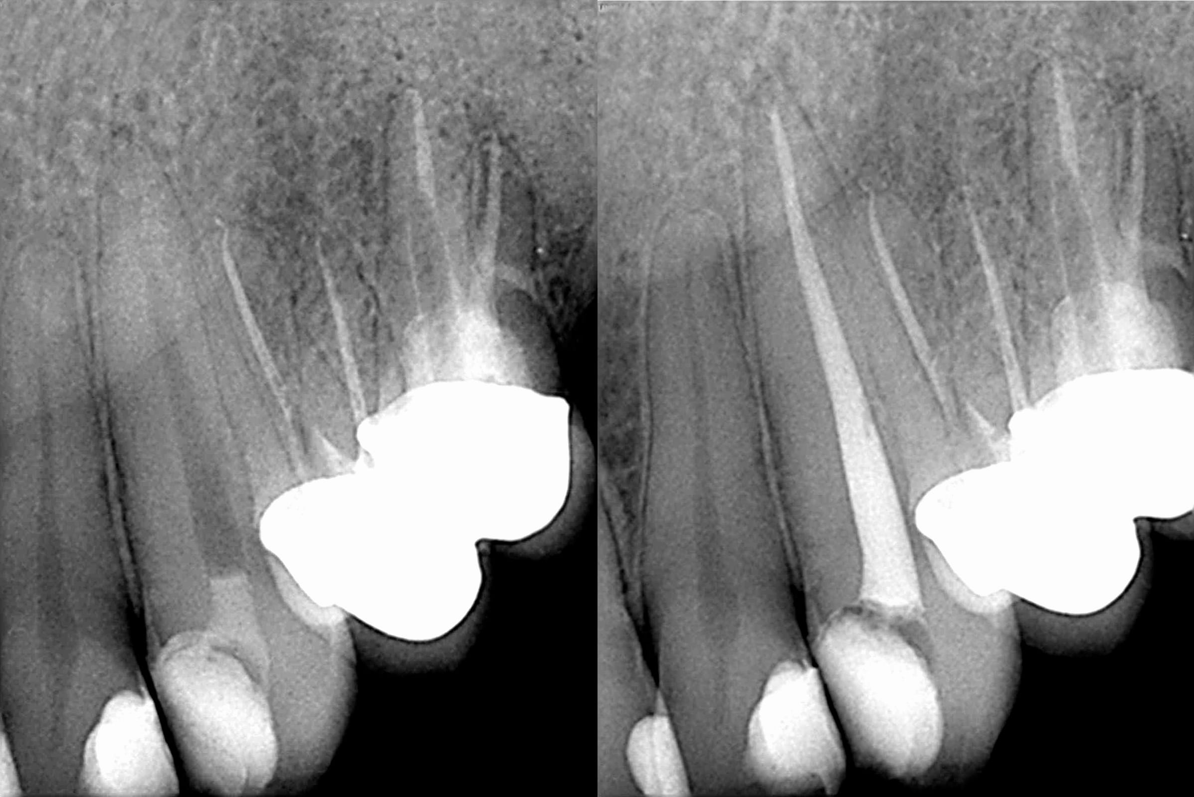 Dental Cysts
