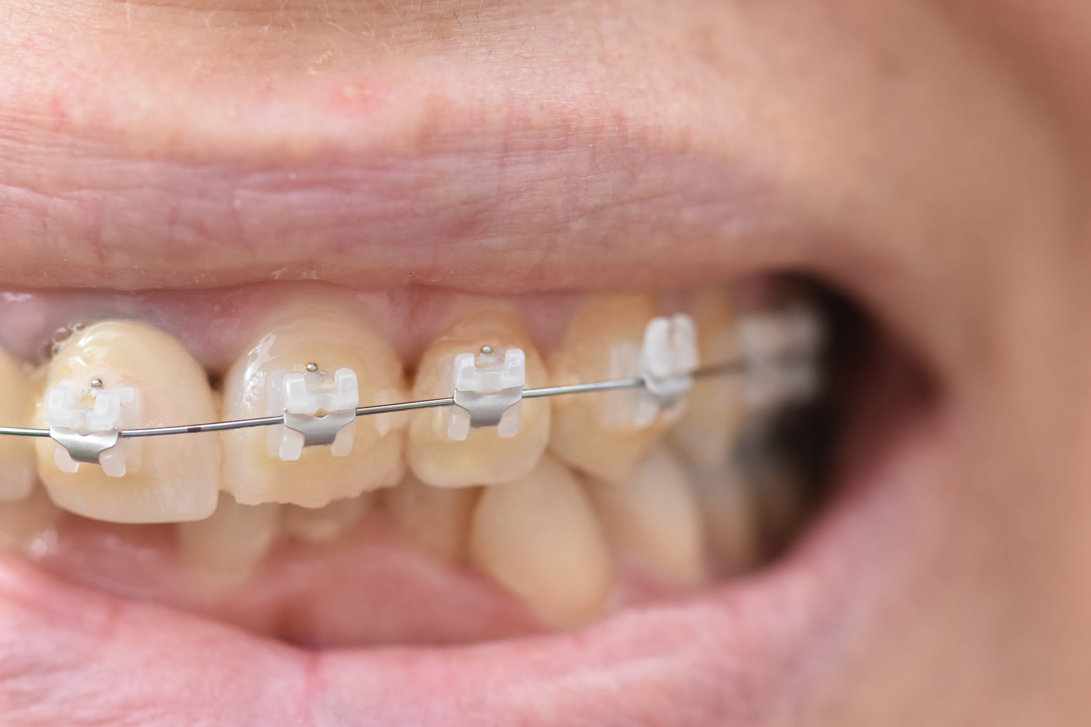 Clear Fixed Braces