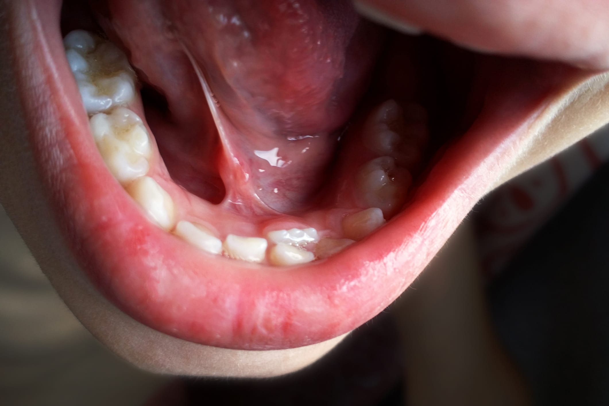Frenectomy