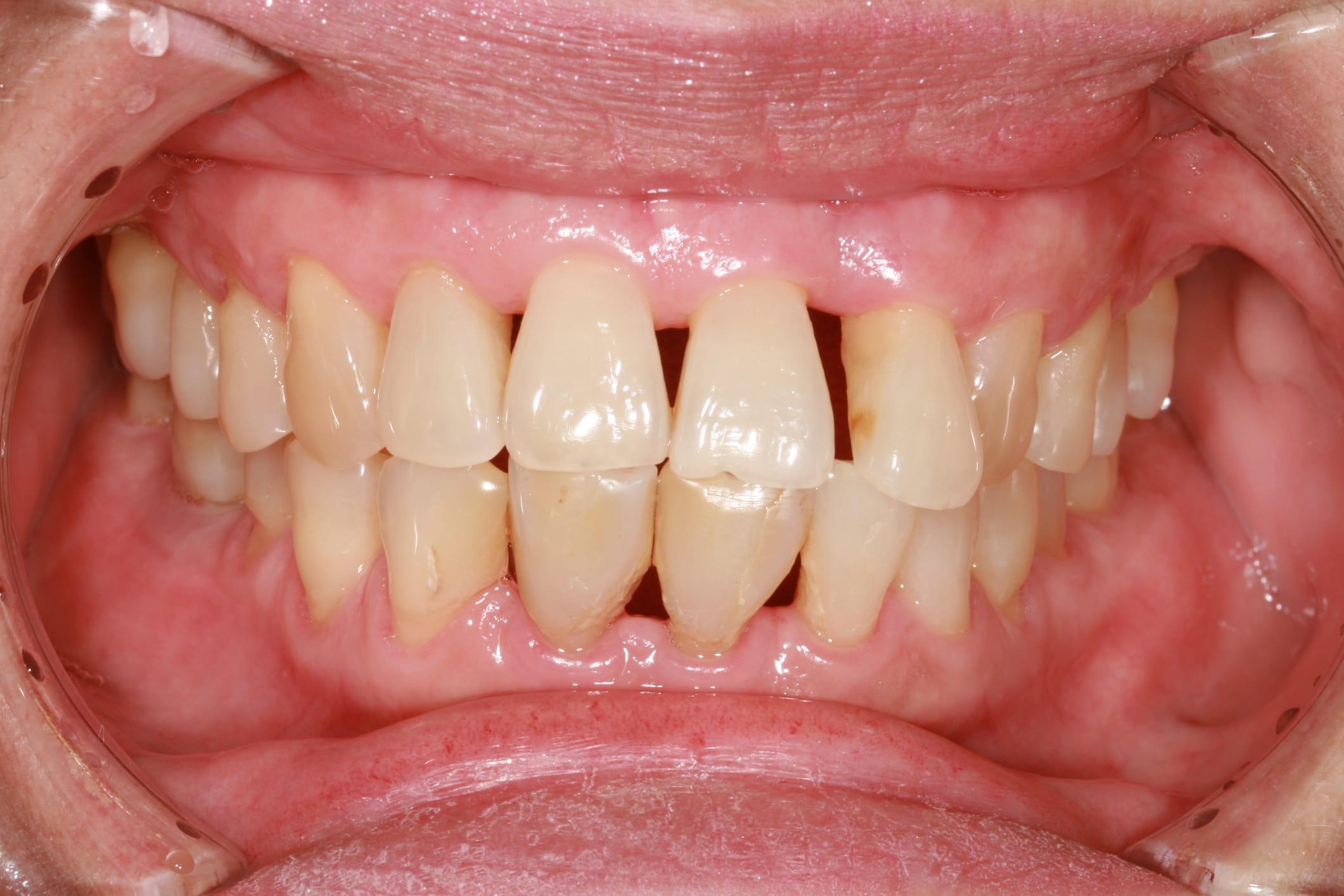 Gum Infections