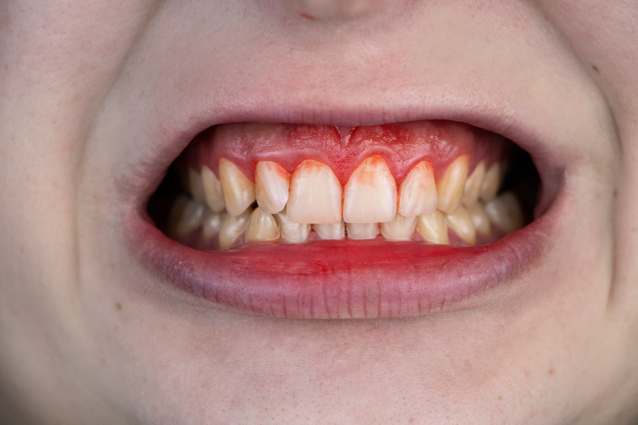 Gingivitis Pain Treatment