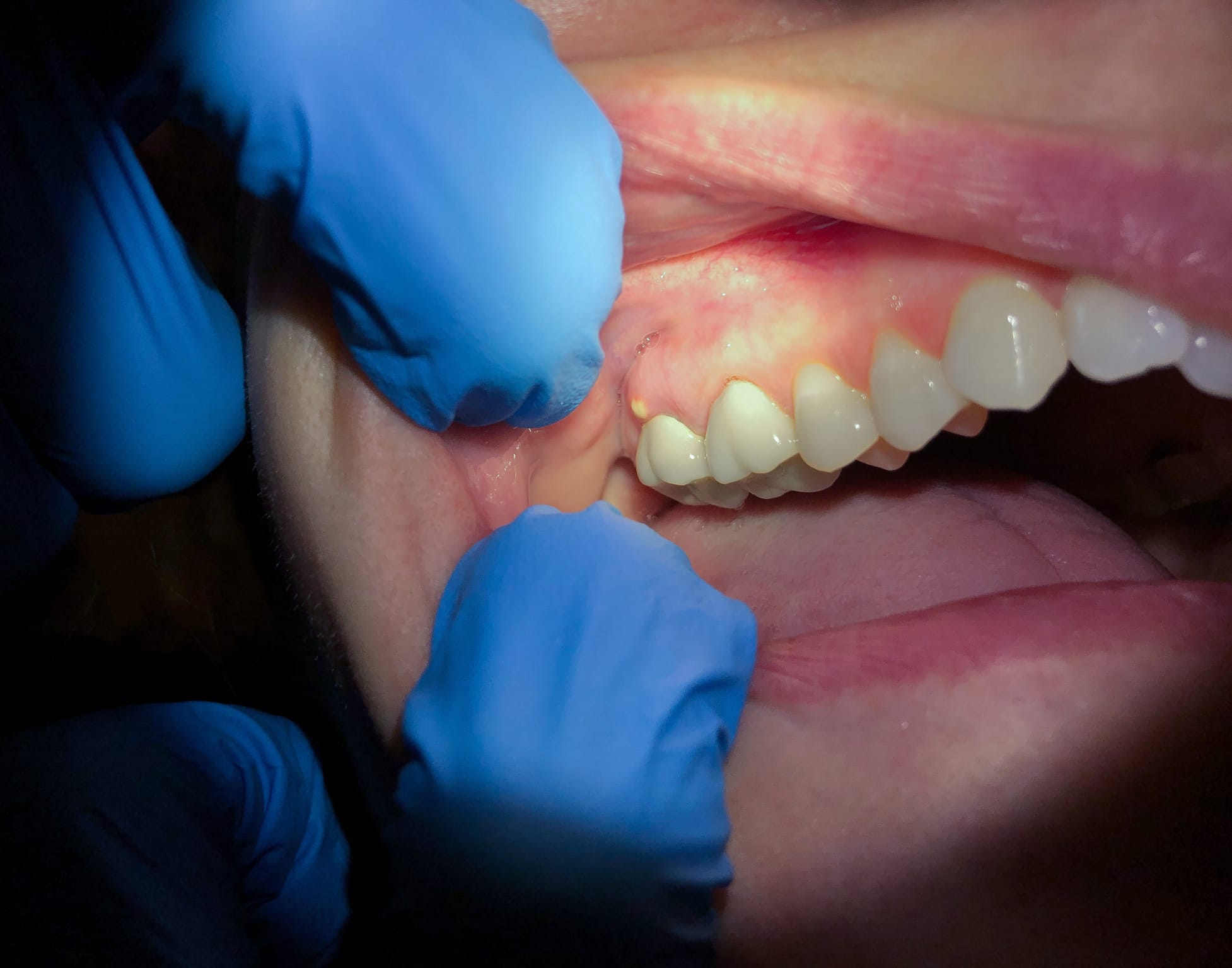 Dental Abscess