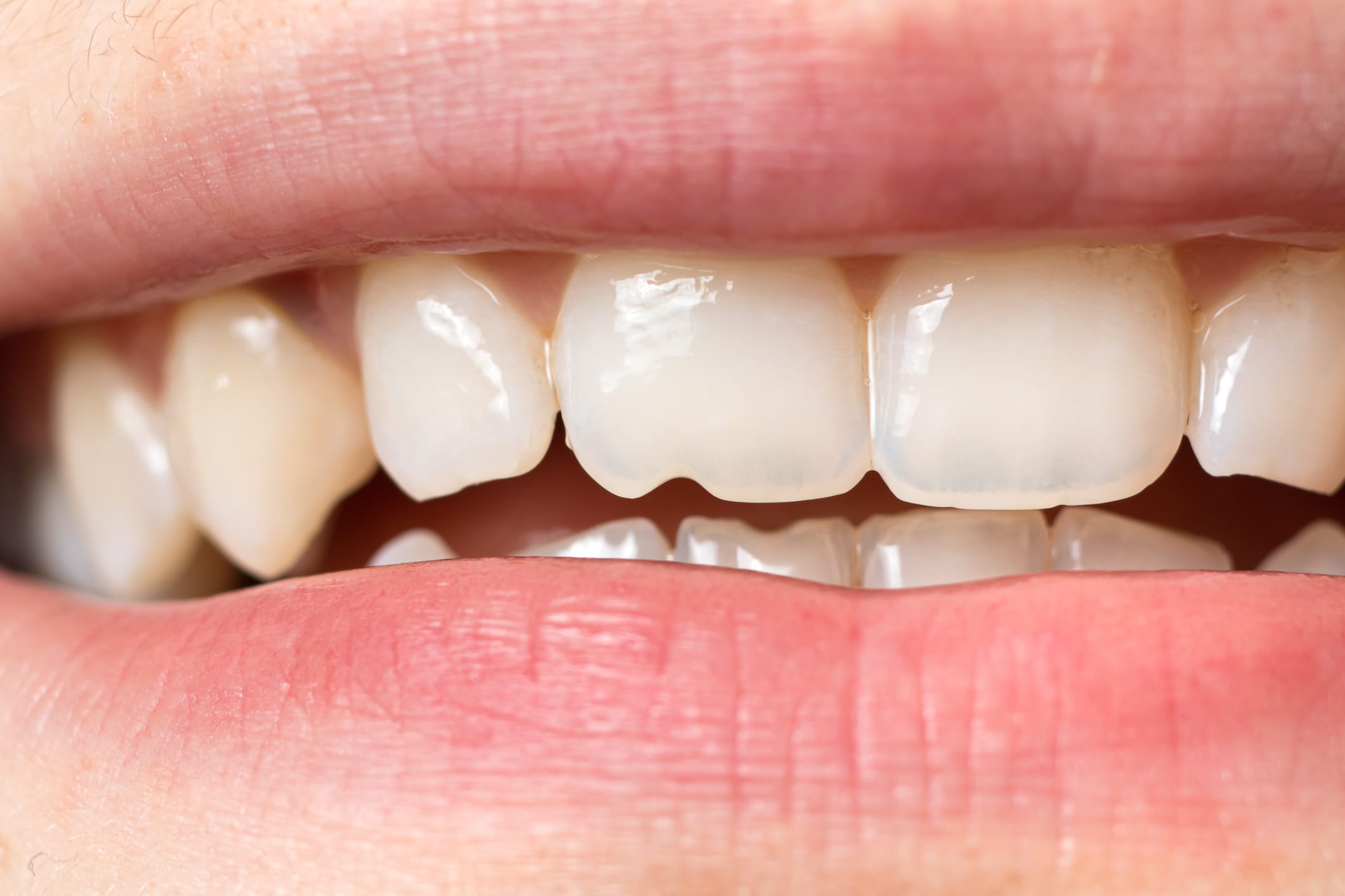 Composite Bonding