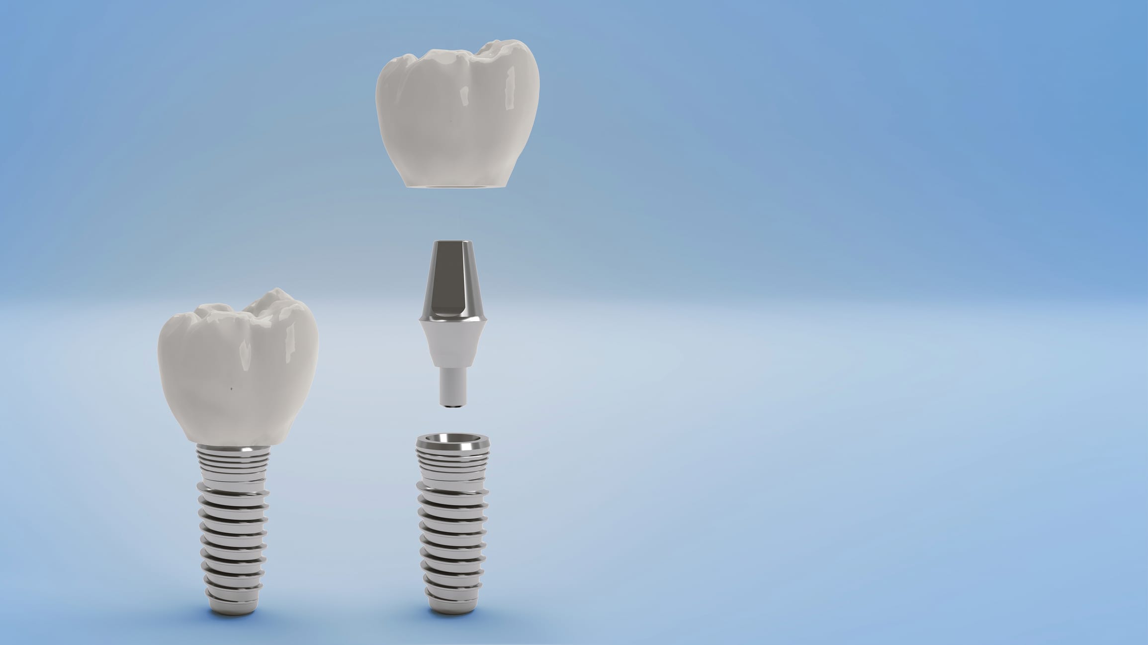 Dental Implants
