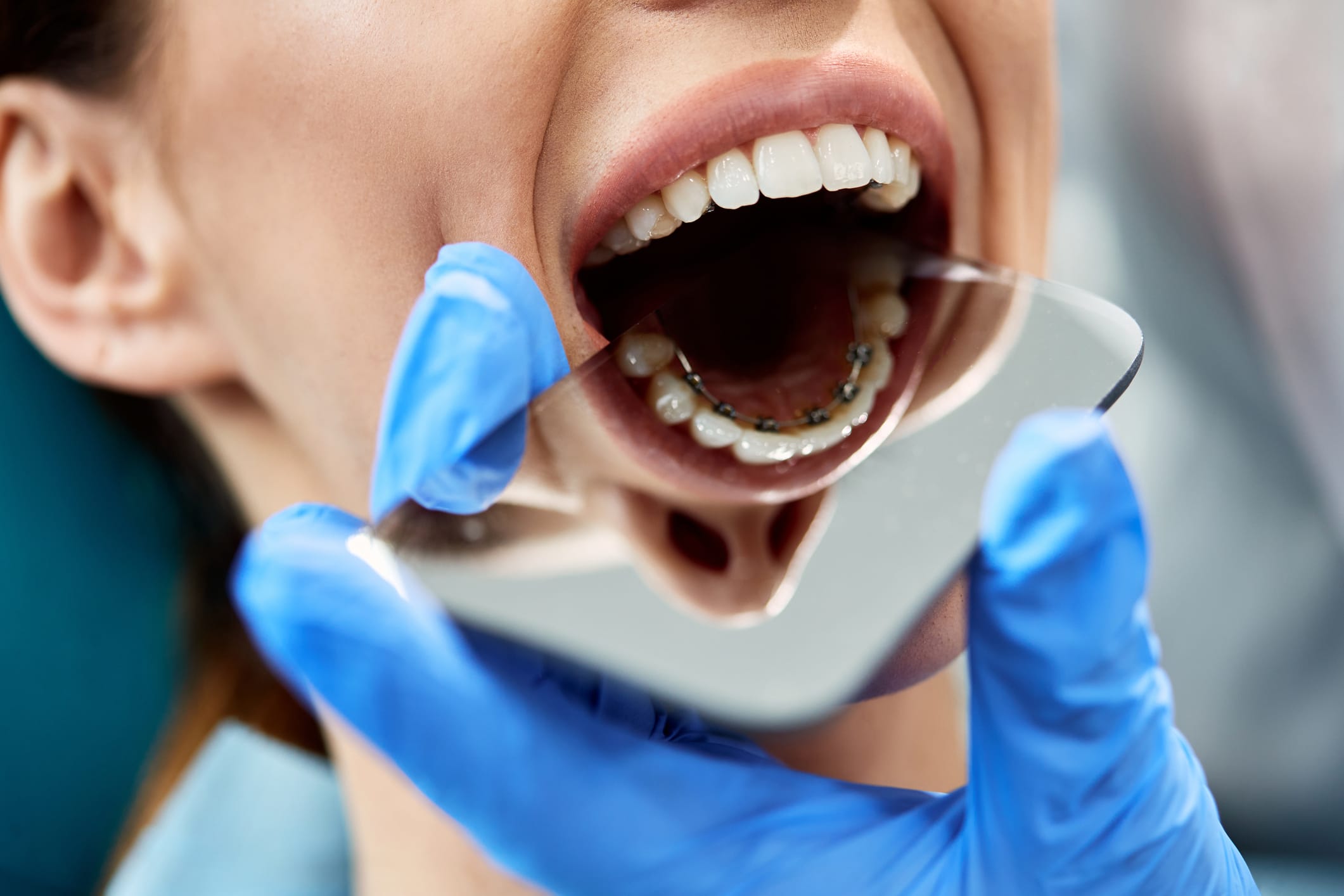 Lingual Braces