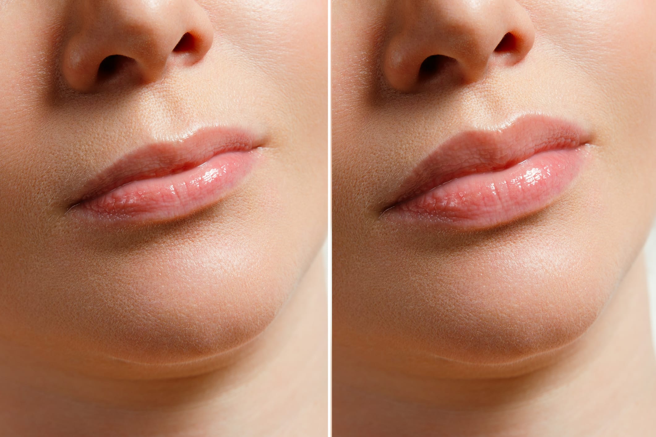 Dermal Fillers