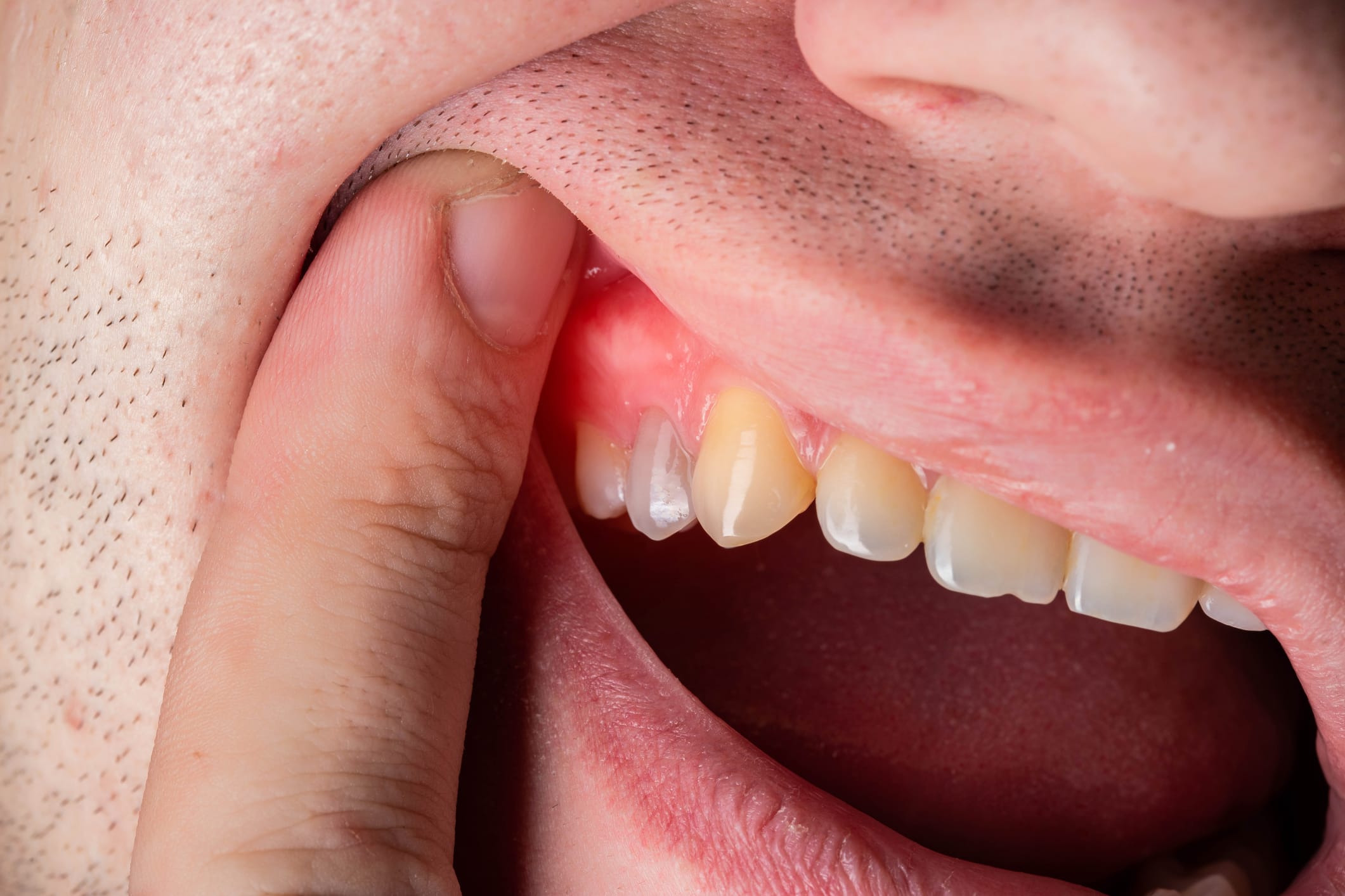 Gum Infections