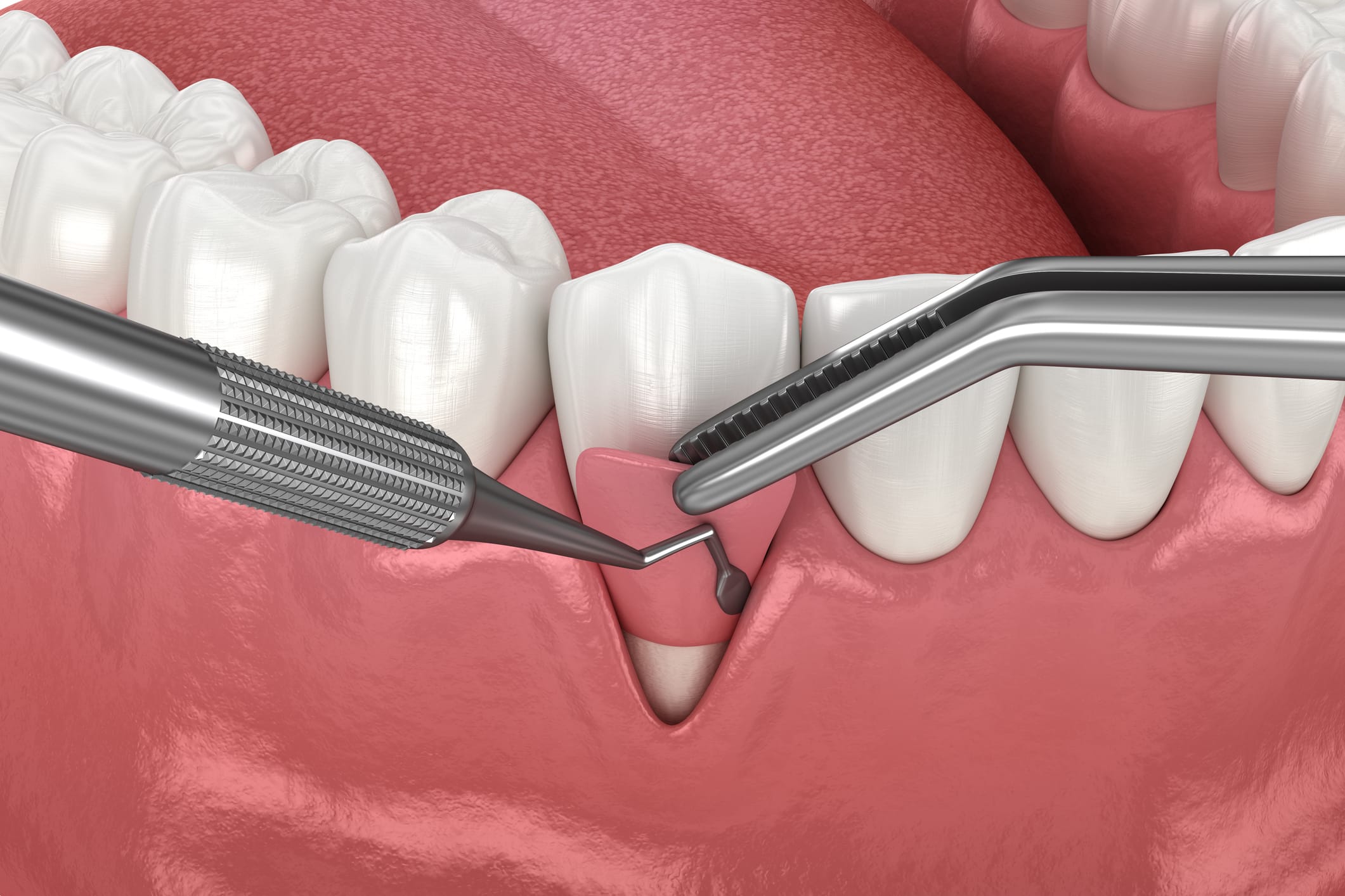 Gum Graft Surgery