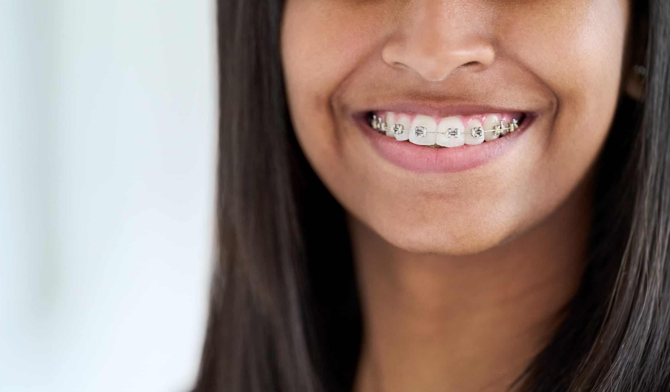 Metal Braces