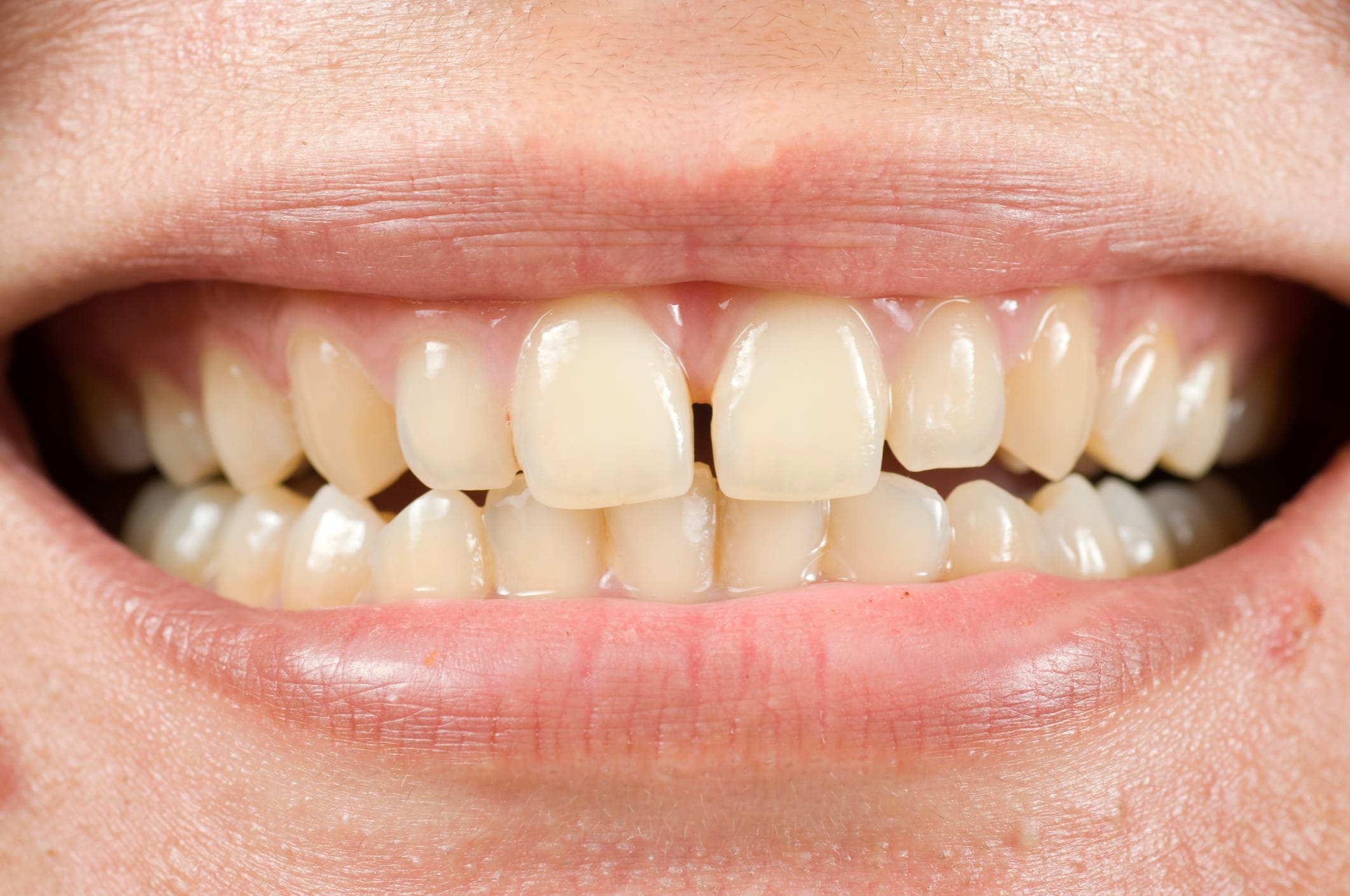 Composite Bonding