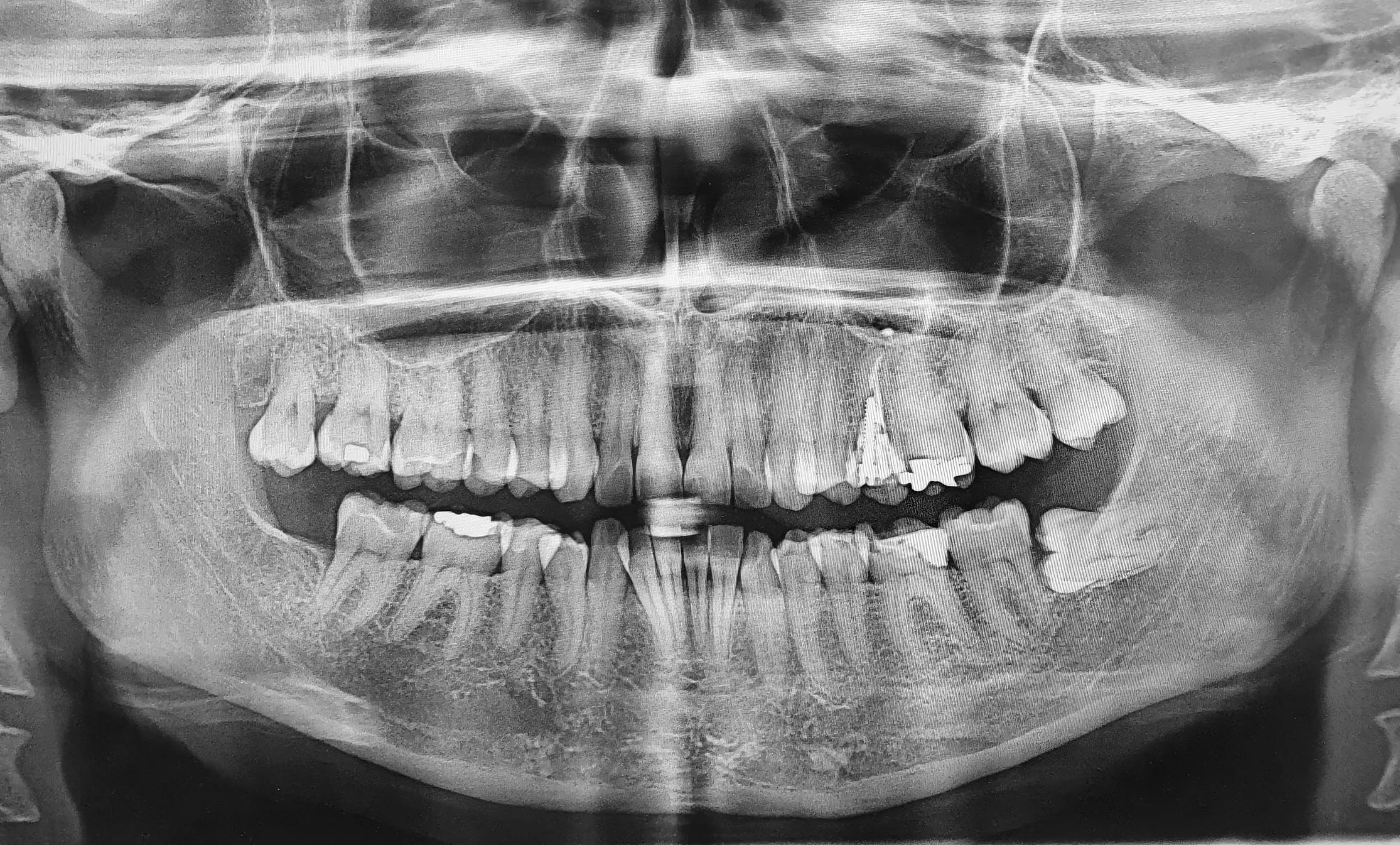 Impacted Wisdom Teeth