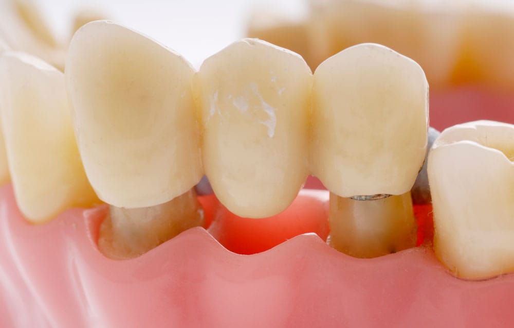 Dental bridge