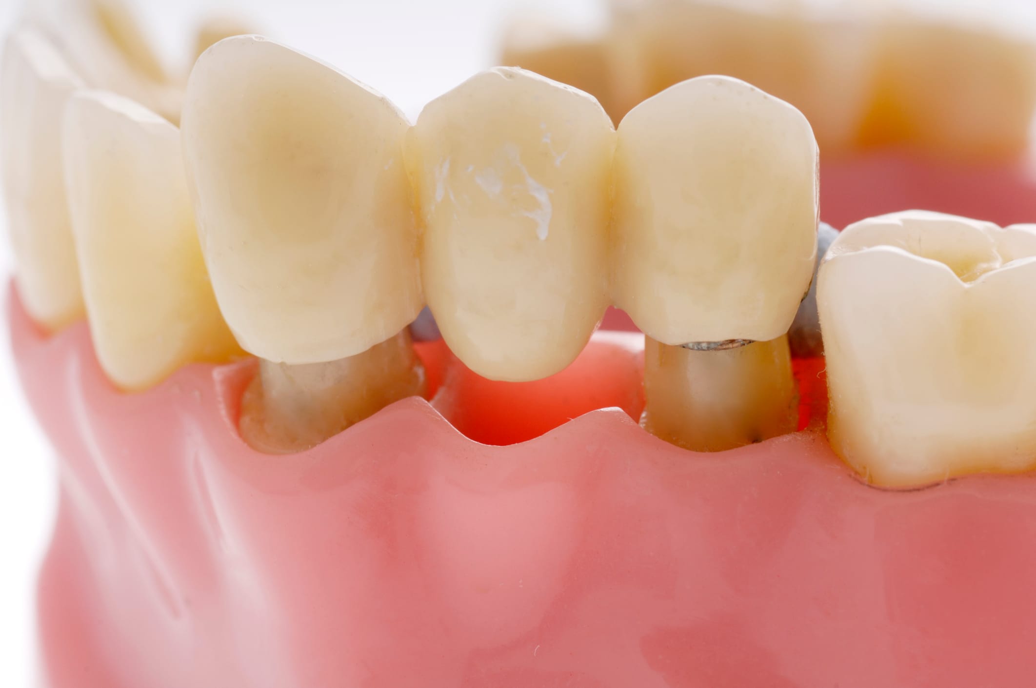 Dental Bridges