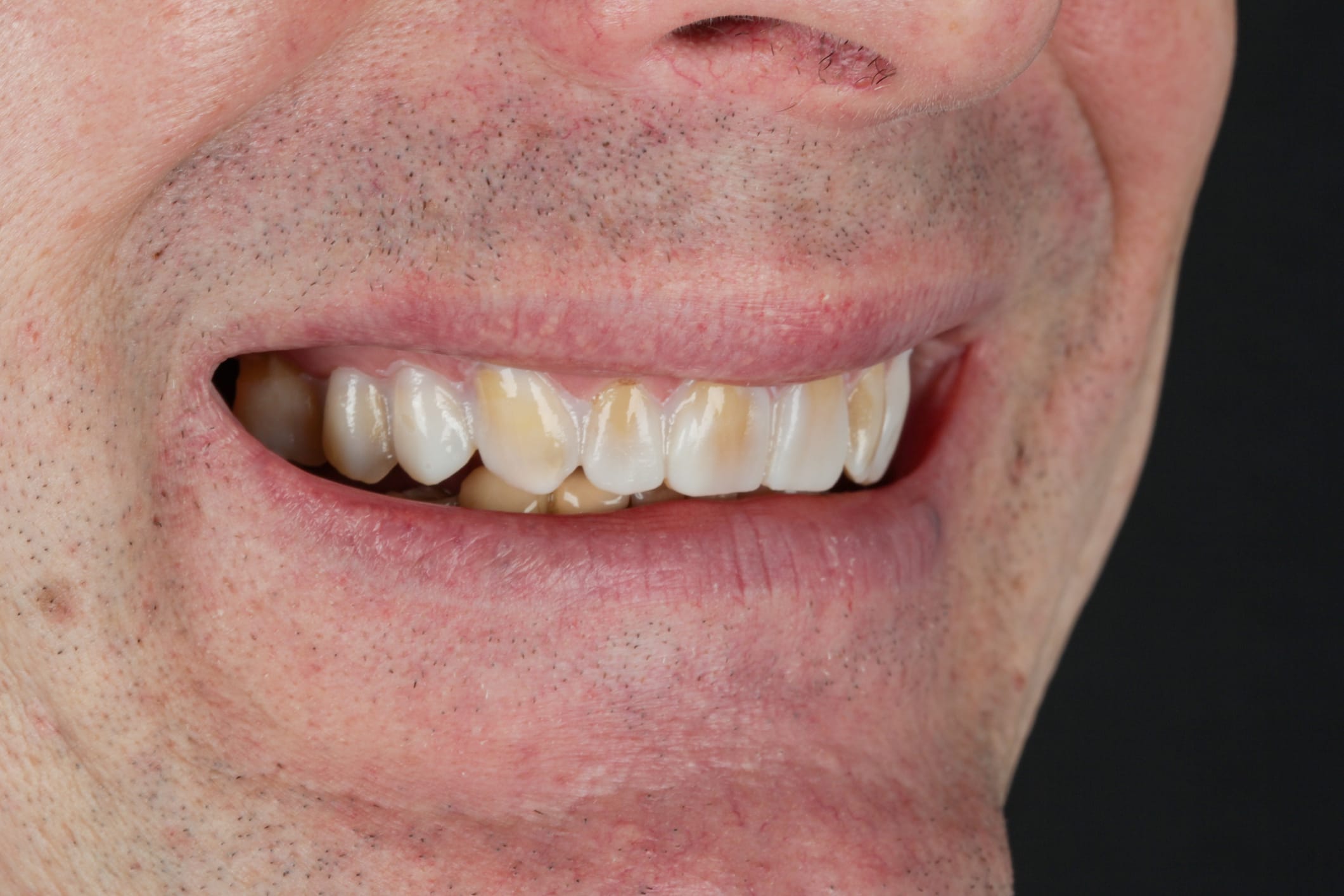 ICON White Spot Treatment