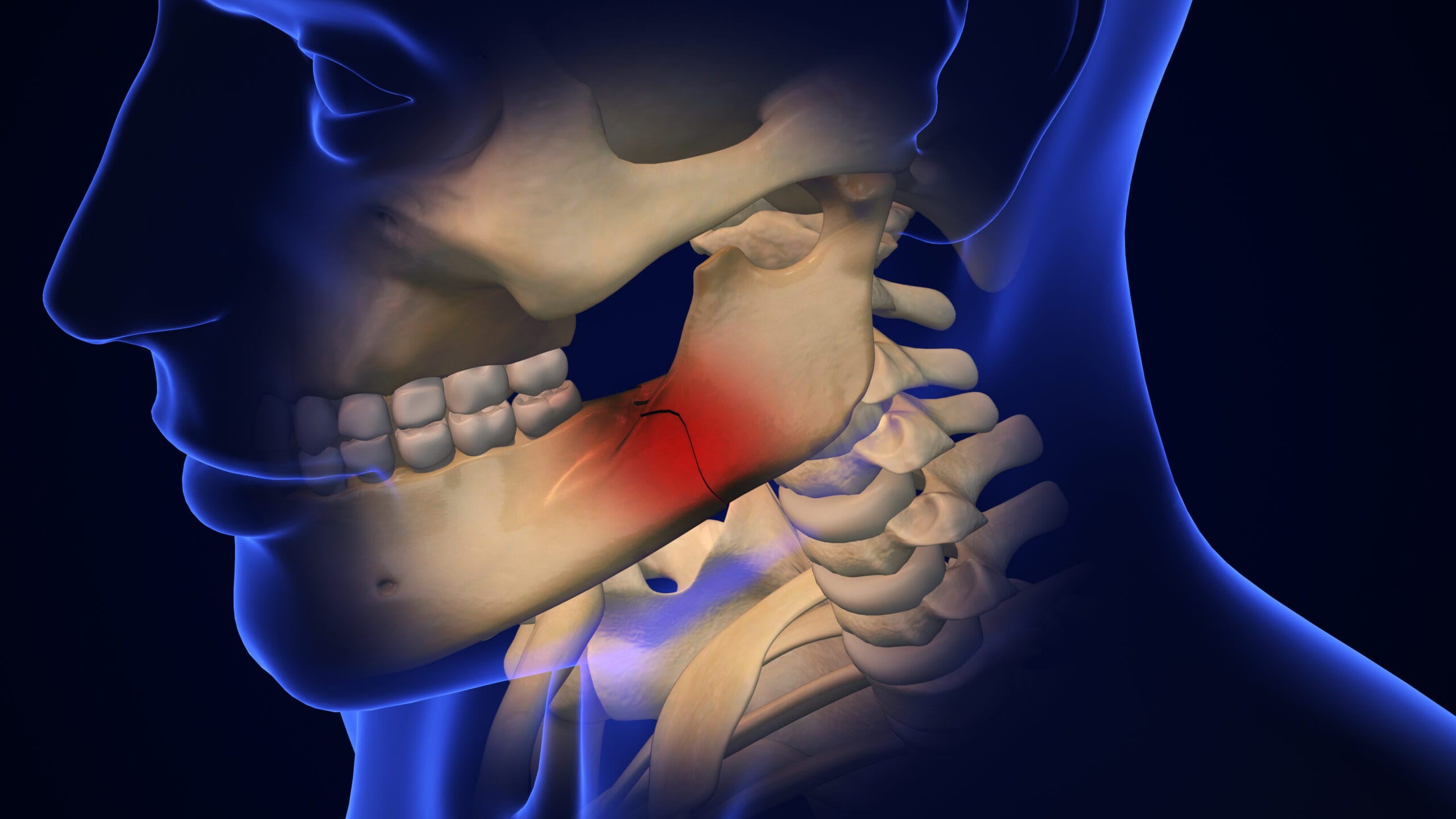 Jaw Injuries
