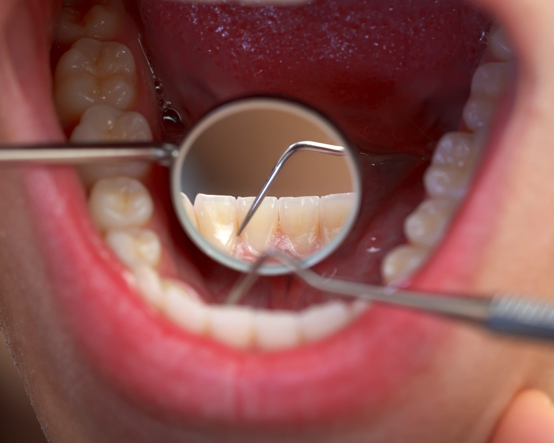 Gum Graft Surgery