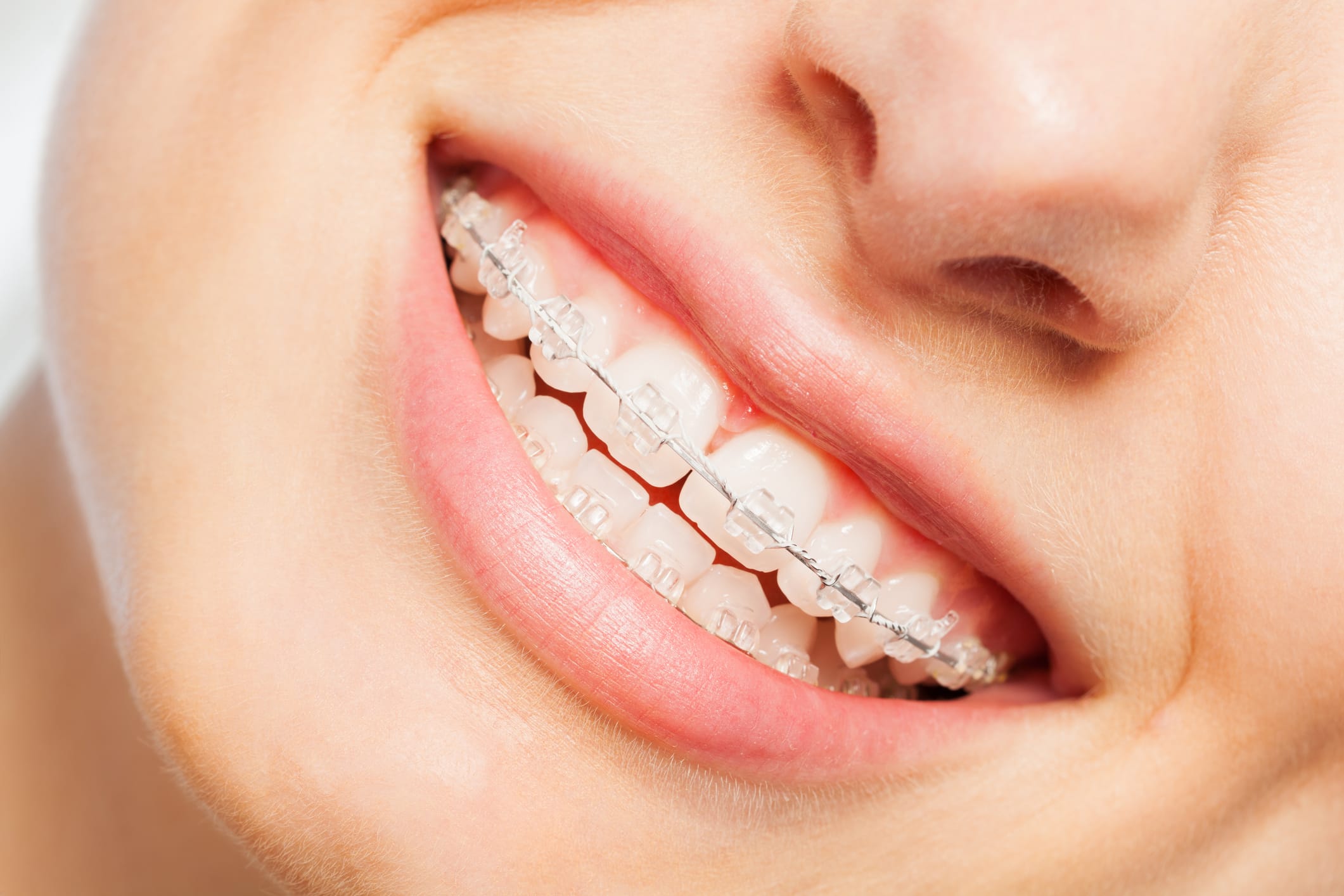 Clear Fixed Braces