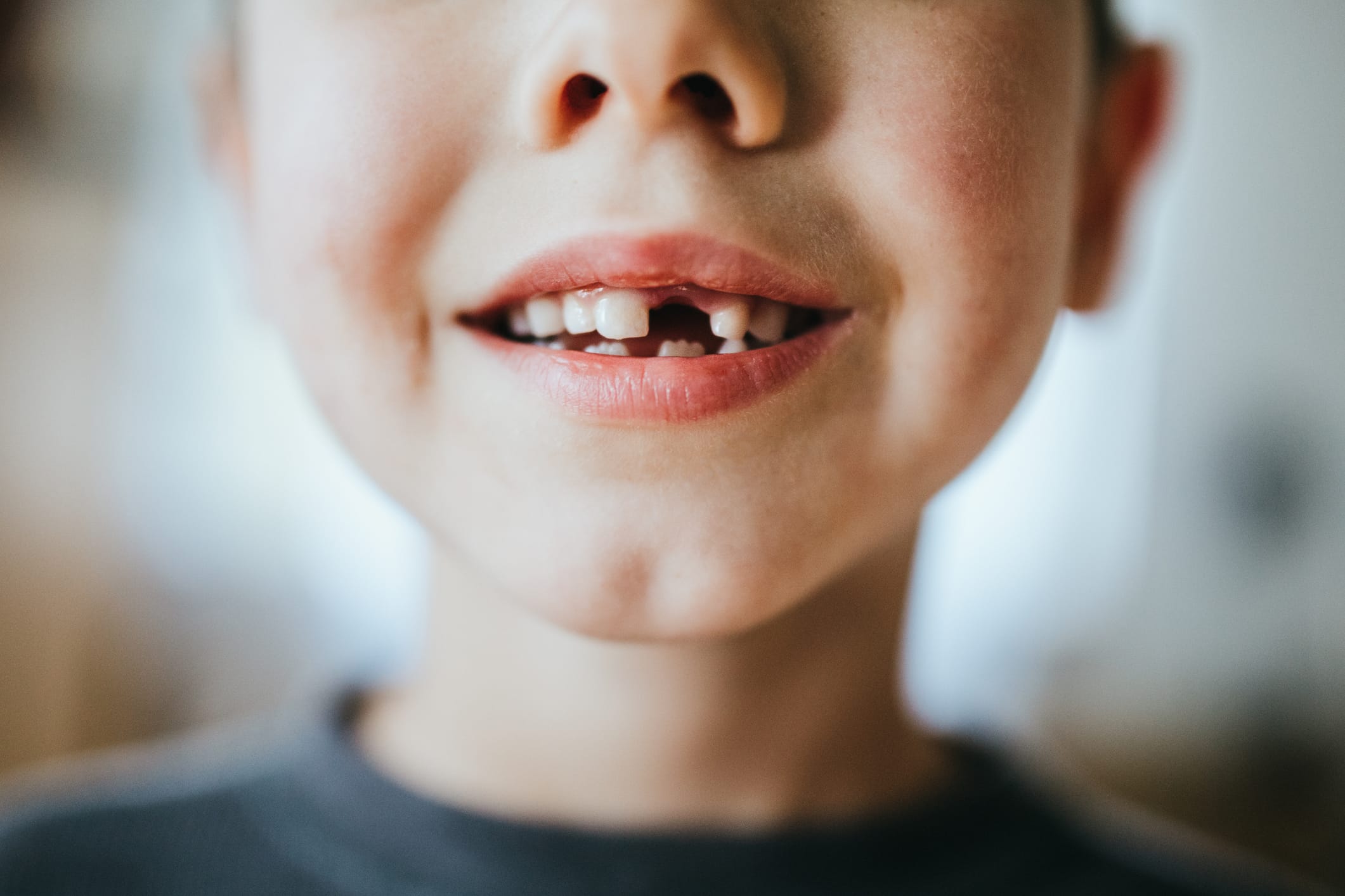 Dental Injuries in Children