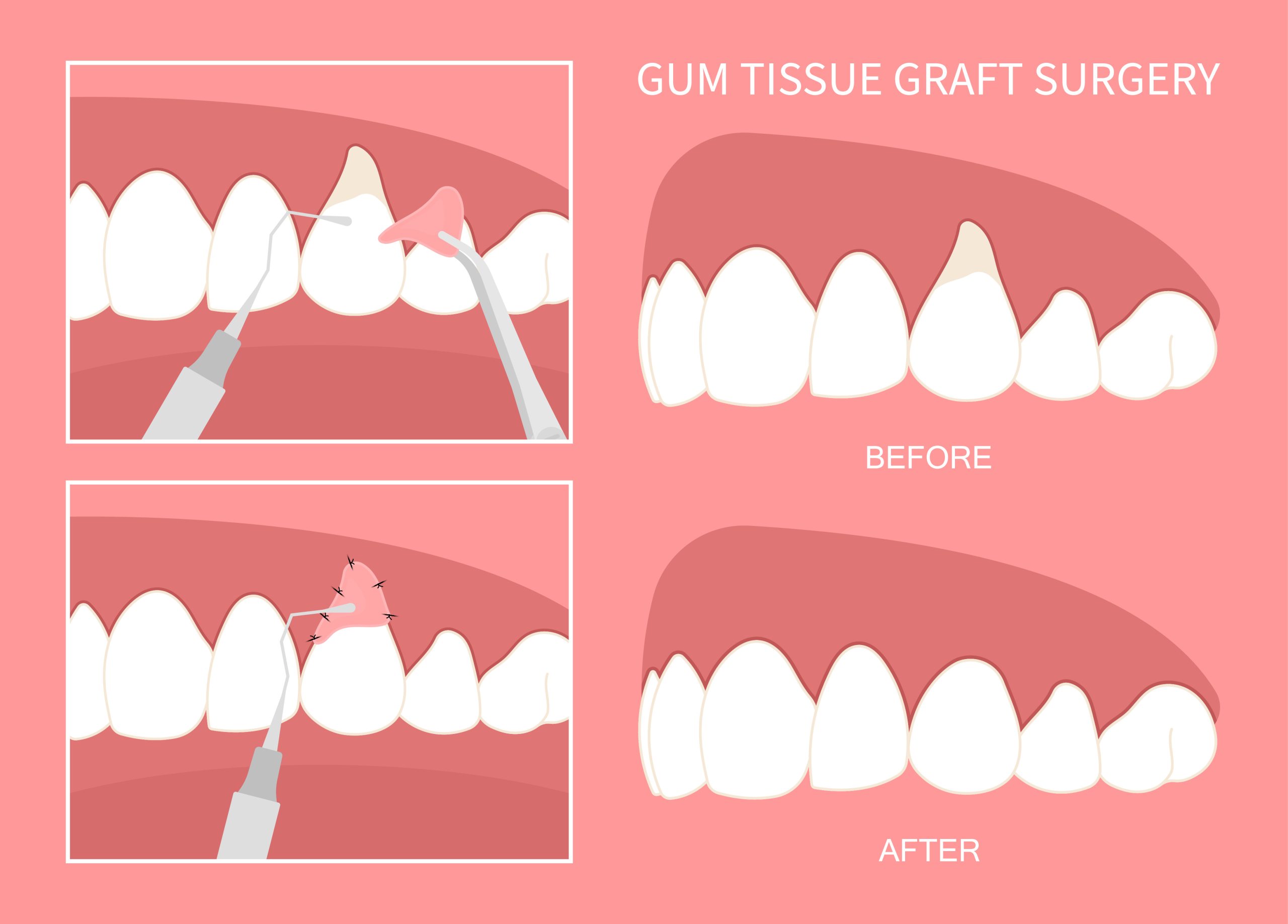 soft tissue graft surgery