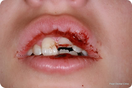 Dental trauma case study image 1