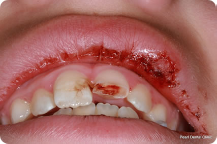 Dental trauma case study image 2