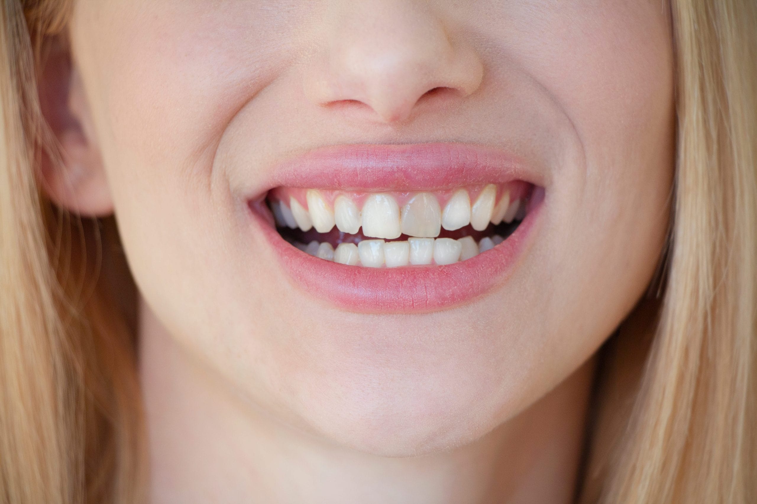 Internal Tooth Whitening