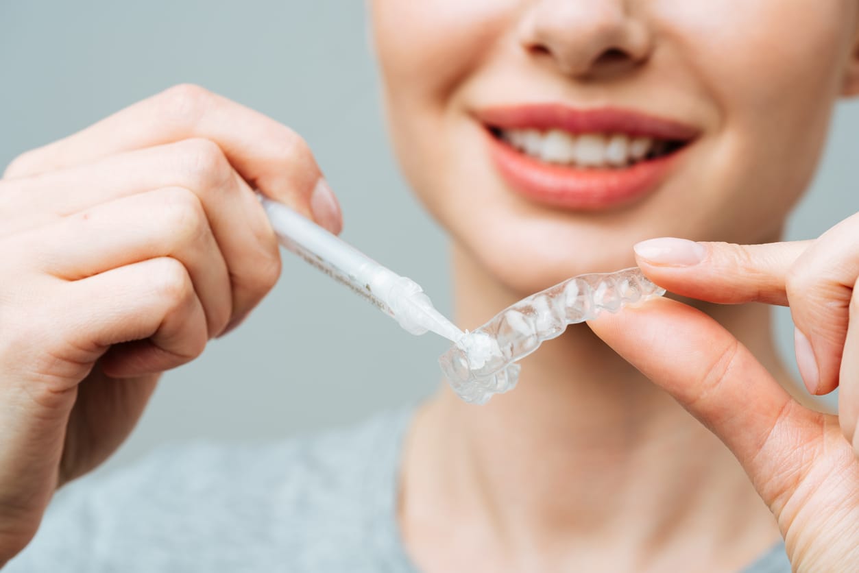 A young woman does a home teeth whitening procedure. Whitening tray with gel