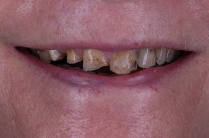 Tooth wear before