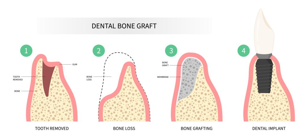 dental bone grafting procedure